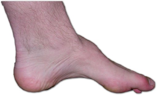 Read more about the article What is Charcot Marie Tooth Disease