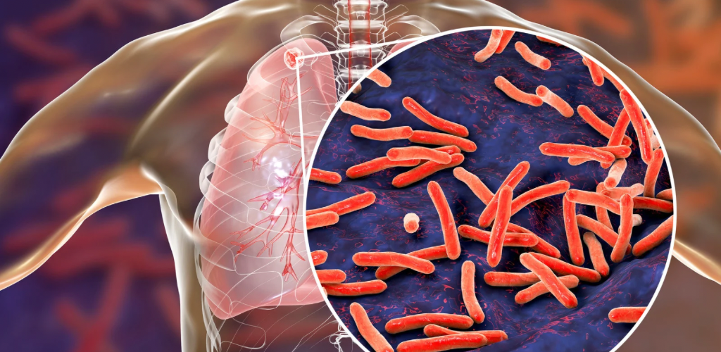Read more about the article How to tackle Pulmonary Tuberculosis(TB): Cause, Symptoms and treatment