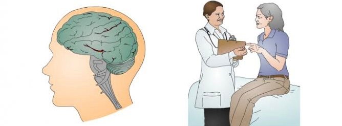 Read more about the article Know more about Creutzfeldt-Jakob disease