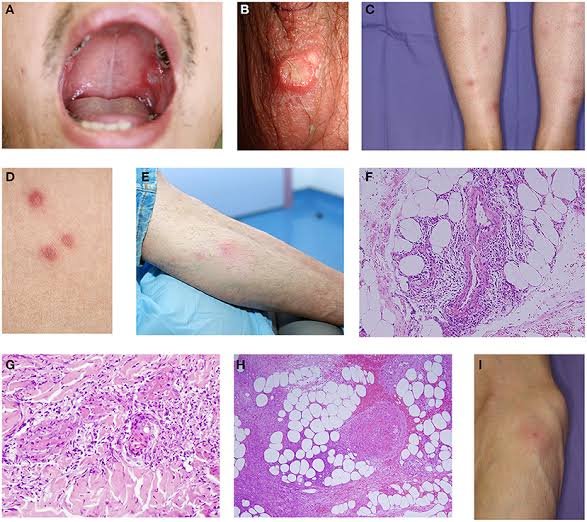 Read more about the article KNOW MORE ABOUT BEHCET’S SYNDROME