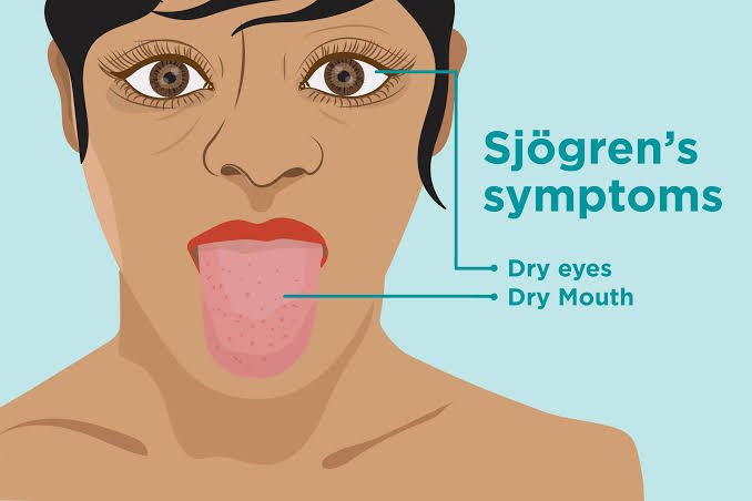 Read more about the article Know more about SJOGREN’S SYNDROME