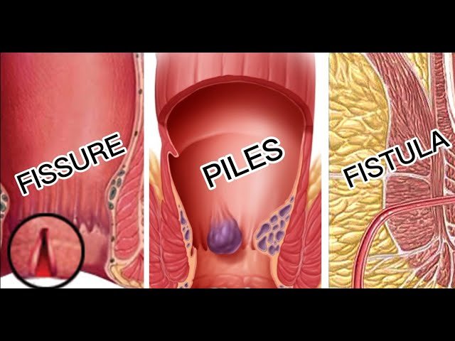 Read more about the article Understanding the Difference between Piles, Fissures, and Fistulas