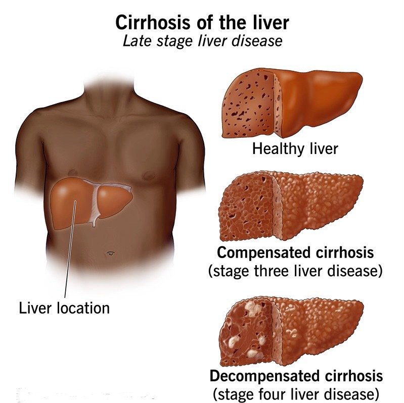 Read more about the article Understanding Cirrhosis: Causes, Symptoms, and Treatment